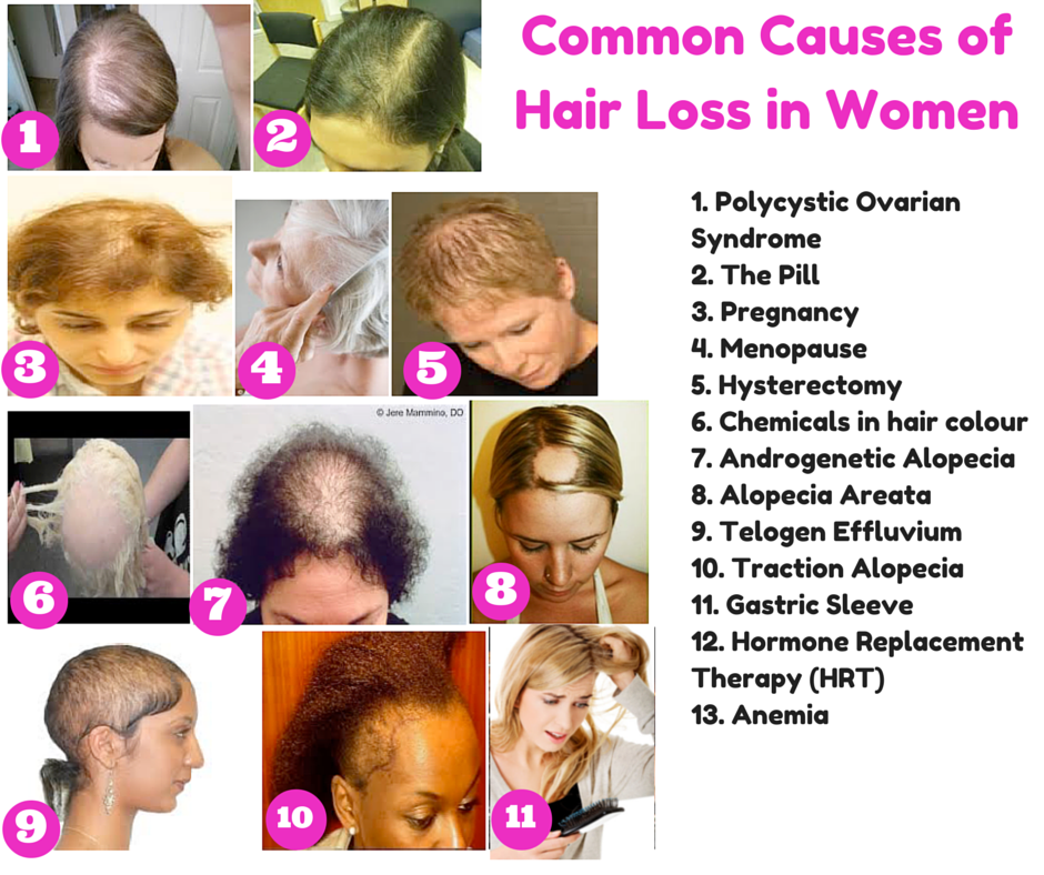 hair loss in women causes