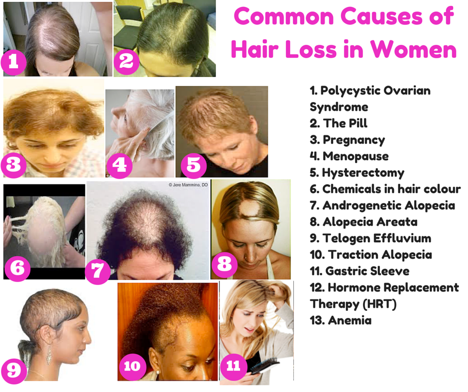 The Top 10 Causes of Hair Loss in Women, and What you Can Do